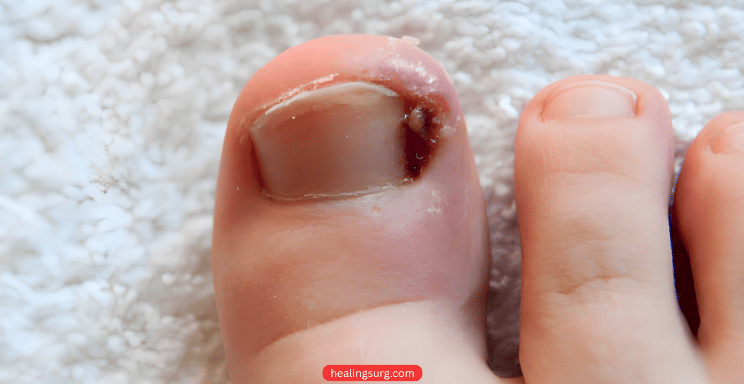 ingrown toenail post blog