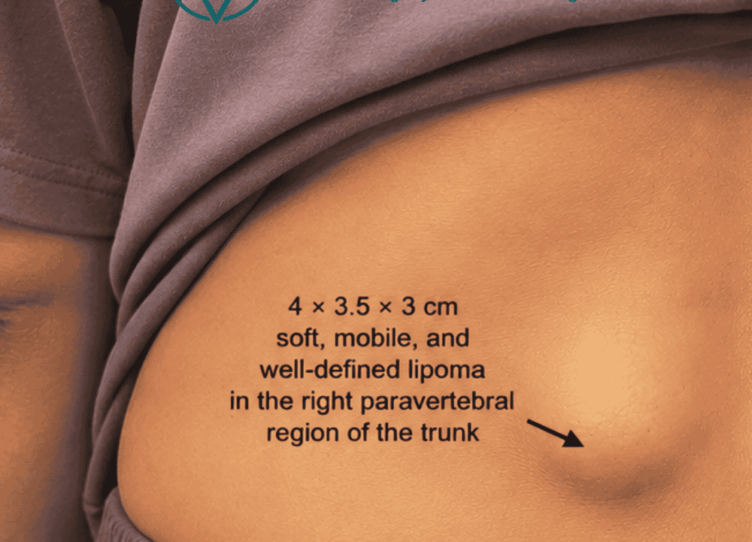 Lipoma-back-of-trunk