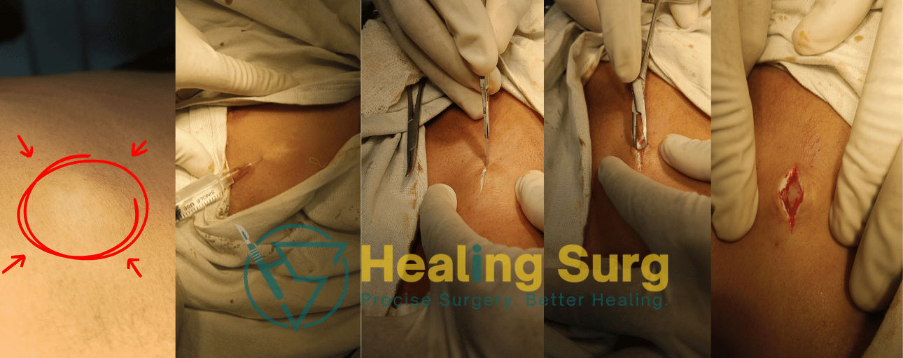 what is a lipoma Lipoma back