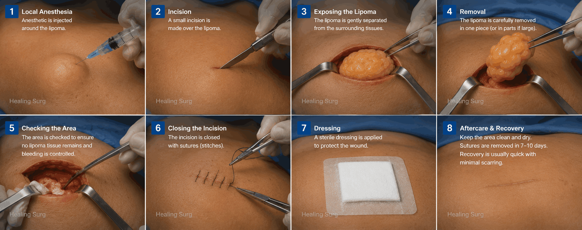Lipoma surgery steps
