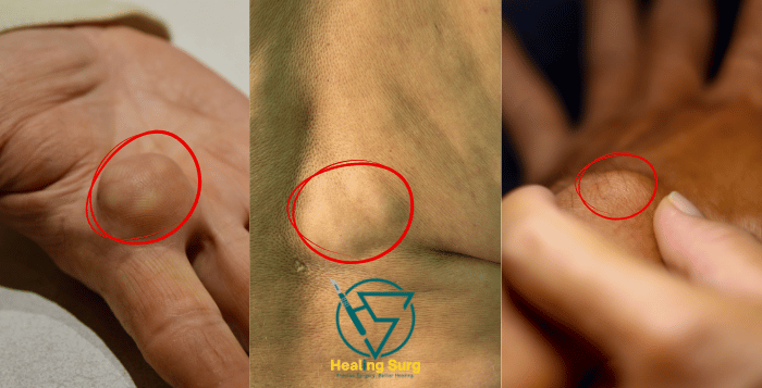 lipoma surgery in bangladesh