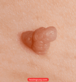 Skin Wart Removal
