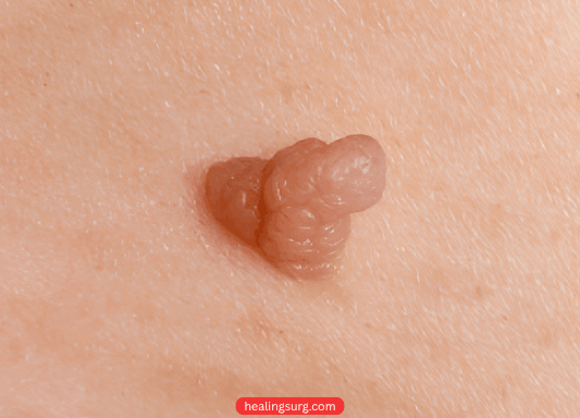 Skin Wart Removal