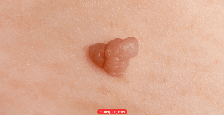 Skin Wart Removal
