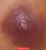 abscess healing surg